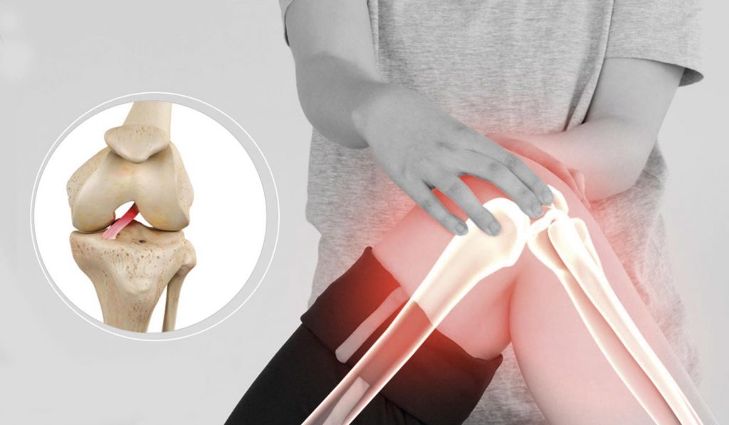 Lesão do Ligamento Cruzado Anterior